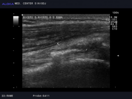 Ultrazvok rame - kalcinacija ob tetivi bicepsa, nad njo vidimo panus (zadebelitev sinovialne ovojnice mišice) - ESWT indikacija